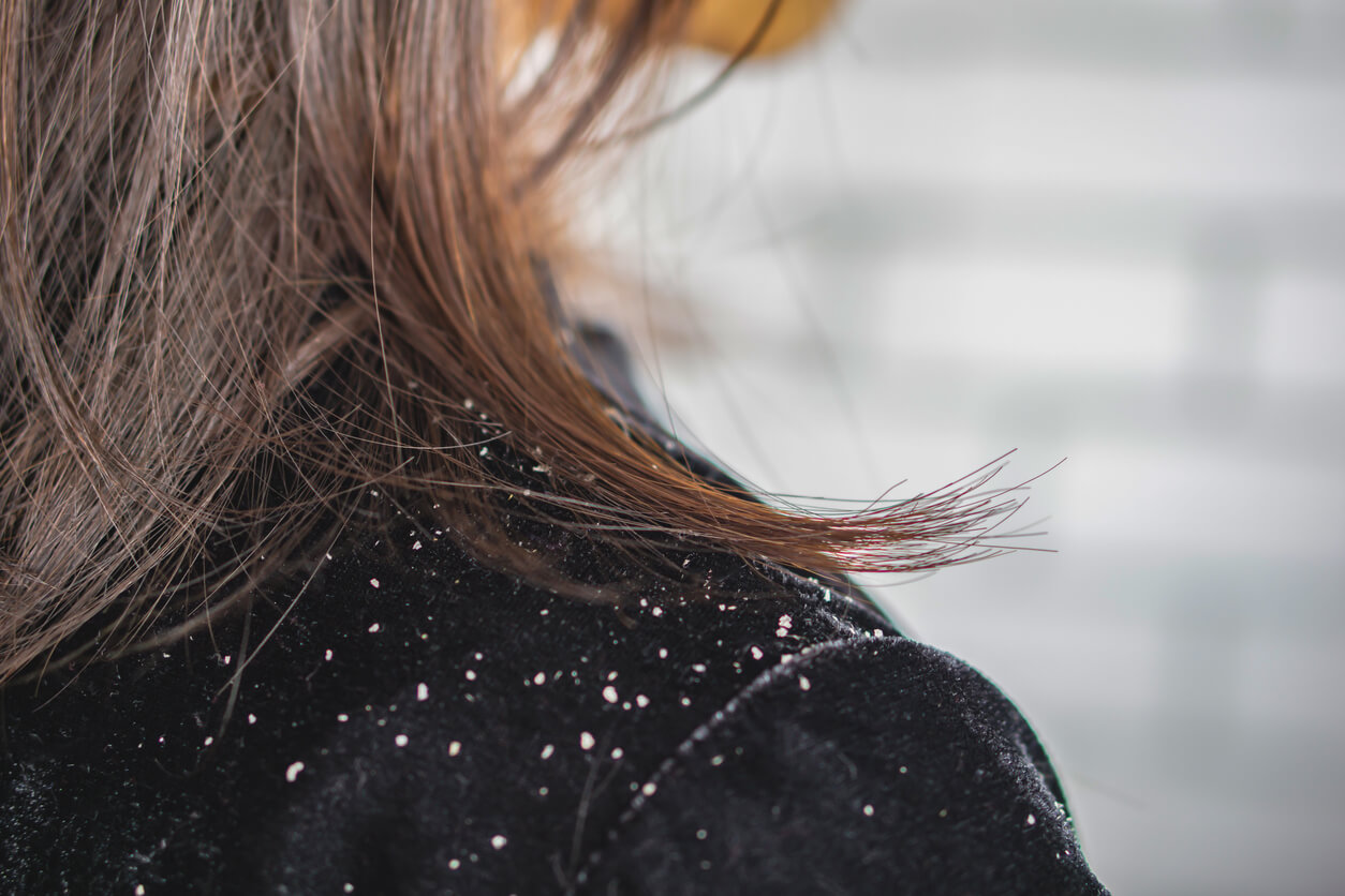 Close-up of white flakes on a person’s dark clothing, indicating scalp issues such as dandruff or dry scalp.